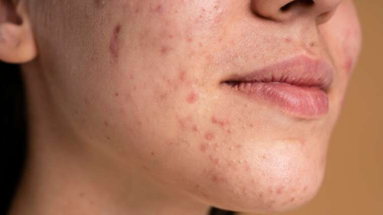 Acne and Acne Scar